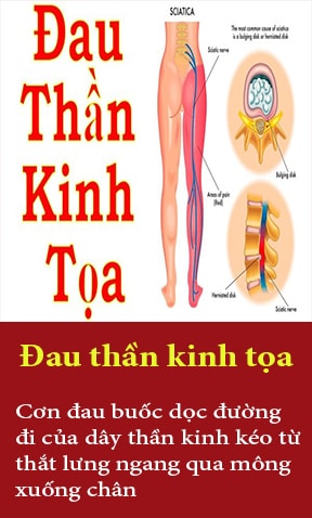 thần kinh tọa
